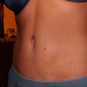 four months post op