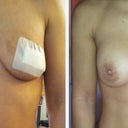 comparision before and 1 day after breast implants removal.