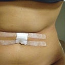 After the operation - 7th March