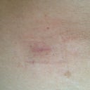Scar around my waists