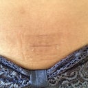 Scar on my abs - 24th April