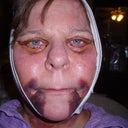 First week after surgery.