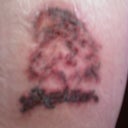 Right after laser