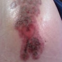 Right after laser