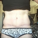almost 7 months post op - Side bulges - UCK!