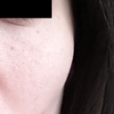 Large tube/lump underneath eye and on cheek from fat transfer, note some pigmentation and pores