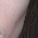 "Contour deformities" from fat graft to cheek. Notice the big depression and how there is no separation with the fat from the upper to lower cheek. Also, notice increased pores and pigmentation on the fat grafted area