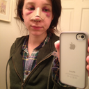 Day 3 post op - bruising and swelling at it's worst (taken December 22, 2011)