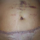 few wks after. still bruised