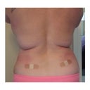 Pre op...5 days...13 days..
