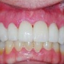 Dental Crowns