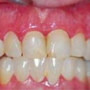 Dental Crowns