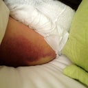 Bruised outer thigh