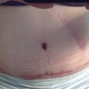 4 wks 2 days post op...
the scar to the side of belly button is my old gall bladder scar. That scar is going to be revised... meaning he will literally cut it out and restitch it to make it much more appealing looking..if a scar can be appealing!