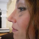 Day 10 post-op profile