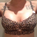 3 weeks post op VS brallette