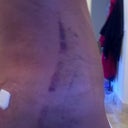 post-op day 3