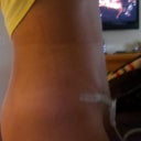approx 2 weeks post-op   drain still in