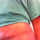 right side- almost 3 weeks post-op