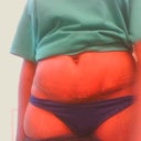 front view - almost 3 weeks post-op. Surgical glue still peeling