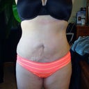 7 Weeks Post OP