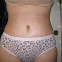 4 weeks post op