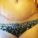 Scar 3 wks PO