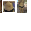 Stretchmarks comparison