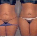 Front before and After