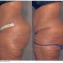 Side View- I think the before and after are reversed