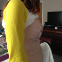 1 day post op