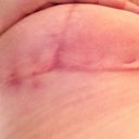 Right incisions, this one is the slower healer