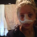 Right after surgery. Large circles under my eyes.