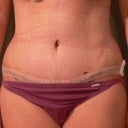 2 Week Post Op Front