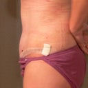 2 Week Post Op side (left drain was taken out today).