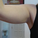 pre-op chubby arms