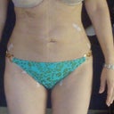 12 days post op frontal view WOW still swollen but very happy