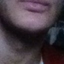 After Cheeks utterly "peeled away" from Lip-Ends. Chin flattened. Broadened. Widened. Face Round and flat instead of sharp and protruding. STARK GAP between Side-Of-Chin / Cheek and Lip-End /Lower Lip. Naso-labial Fold disconnected.