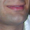 Before. Same pic to be compare with the next.. Chin sharp. Full of volume. Protruding forward. Face sharp. Like crescent moon shape. Pointed long, sharp features. ChinSides/Cheek very close to Lower Lip/ Lip-Ends. Chin Tip upturned.