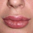 One day post injection. swelling in upper left, lower right and top middle. 