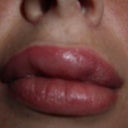restylane lips up close