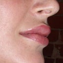 restylane lips profile