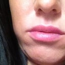 One month after juvederm