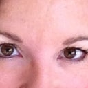 This is after the last Botox series