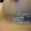 Incision - day 2