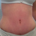 My new tummy 13 dpo! Still a bit of swelling but I have a normal belly button!