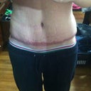 Swelling on my right hip. Pod 12
