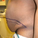 close up side view rite before surgery