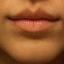 before filler in lips