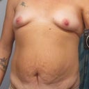 I'm hoping to have my breasts enlarged also.